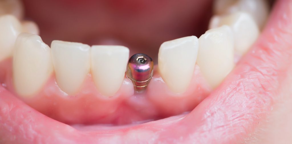 implantes dentários_em_tottenham