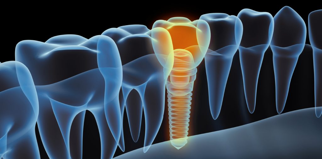 dental_implants_near_me